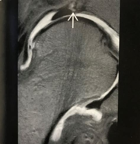 accuracy of acetabular labrum tear tests|acetabular labral tear imaging.